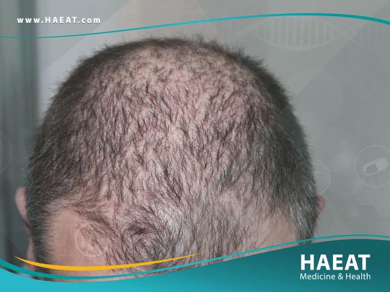 أفضل وأضمن طريقة لزراعة الشعر في العالم