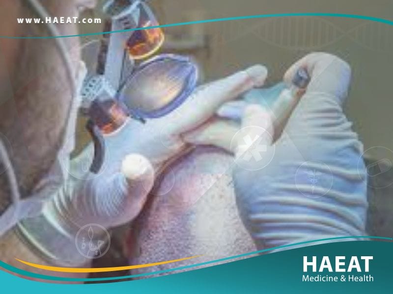 أفضل وأضمن طريقة لزراعة الشعر في العالم