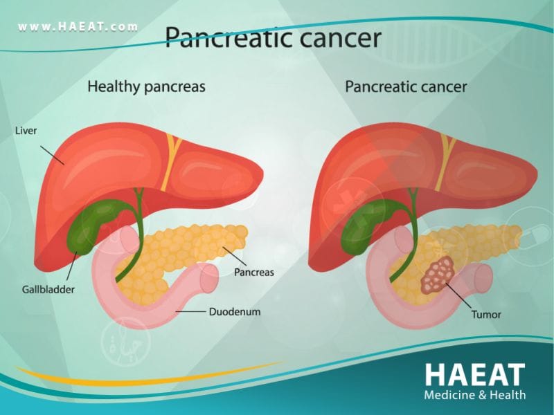 سرطان البنكرياس