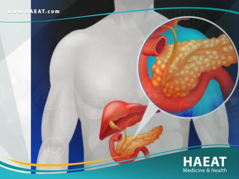 سرطان البنكرياس