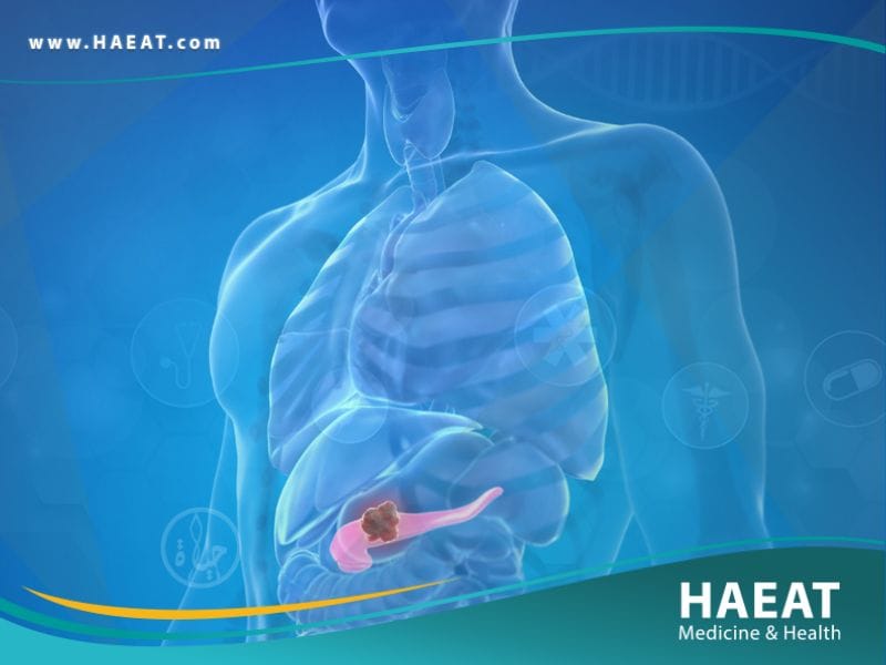 سرطان البنكرياس