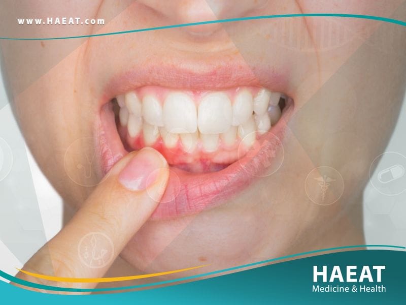 أمراض اللثة