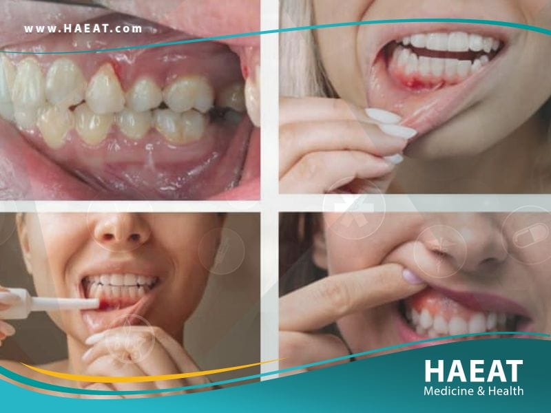 أمراض اللثة