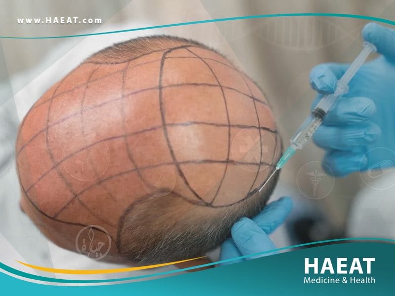 الدول الافضل لزراعة الشعر بالترتيب