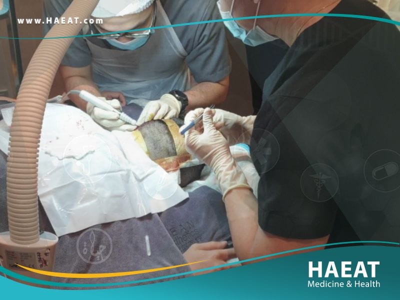 الدول الافضل لزراعة الشعر بالترتيب