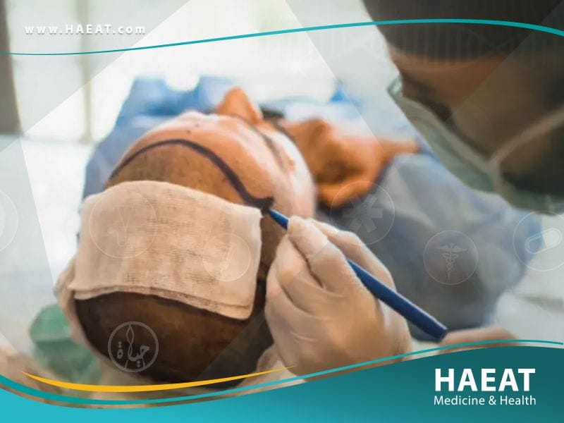 الدول الافضل لزراعة الشعر بالترتيب