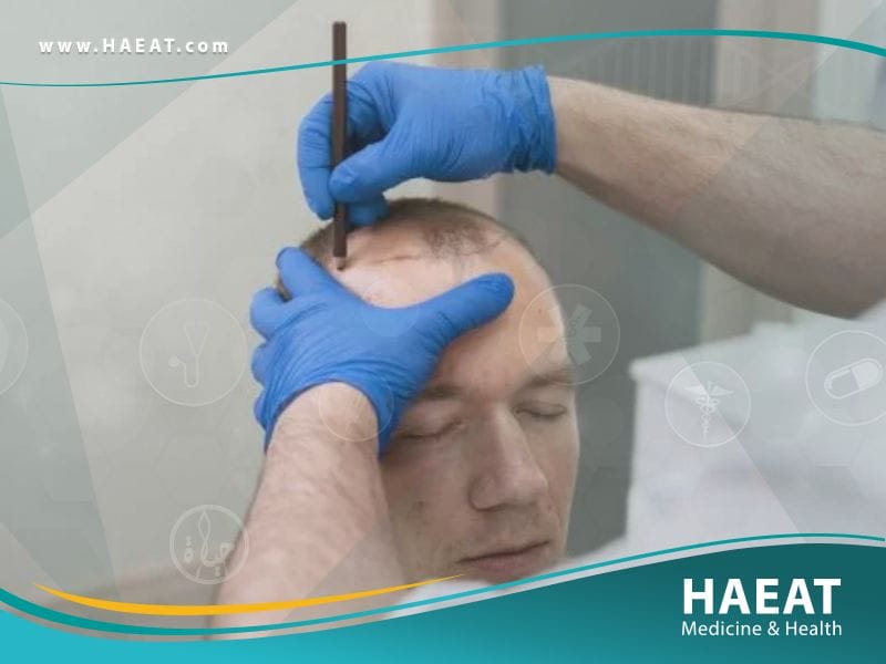 الدول الافضل لزراعة الشعر بالترتيب