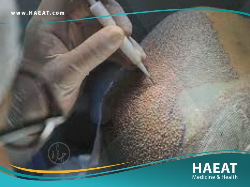 الفرق بين تقنية DHI و FUE