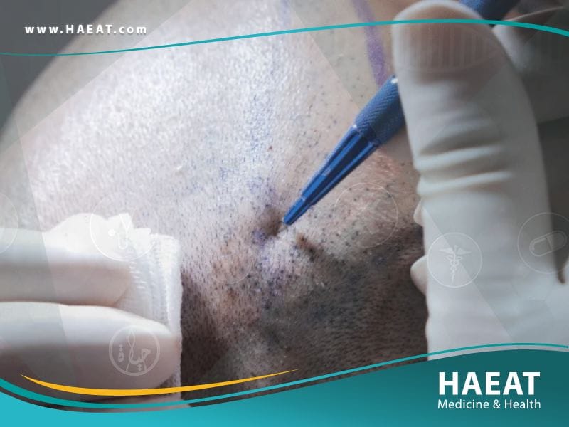 الفرق بين تقنية DHI و FUE