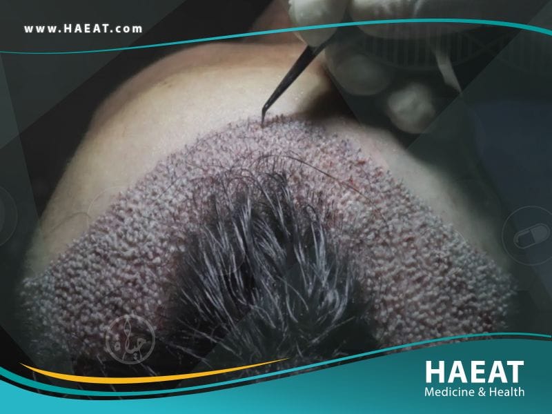 الفرق بين تقنية DHI و FUE