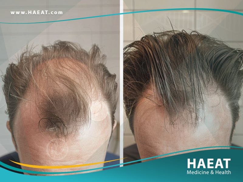 الفرق بين زراعة الشعر بتقنية البيركوتان وتقنية الخلايا الجذعية