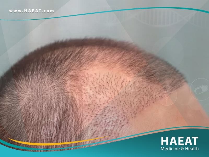 الفرق بين زراعة الشعر بتقنية البيركوتان وتقنية الخلايا الجذعية
