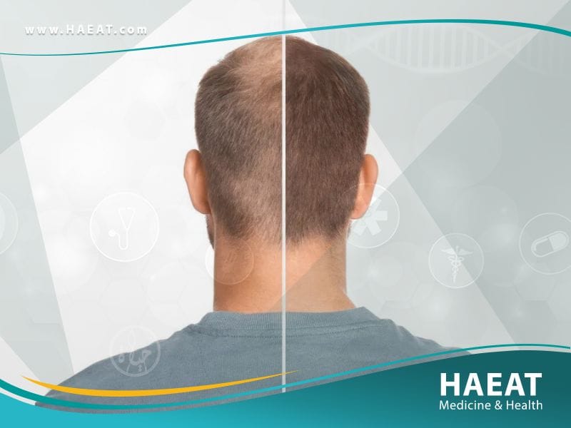 الفرق بين زراعة الشعر بتقنية DHI وتقنية FUE
