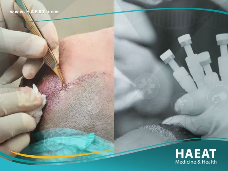 الفرق بين زراعة الشعر بتقنية DHI وتقنية FUE