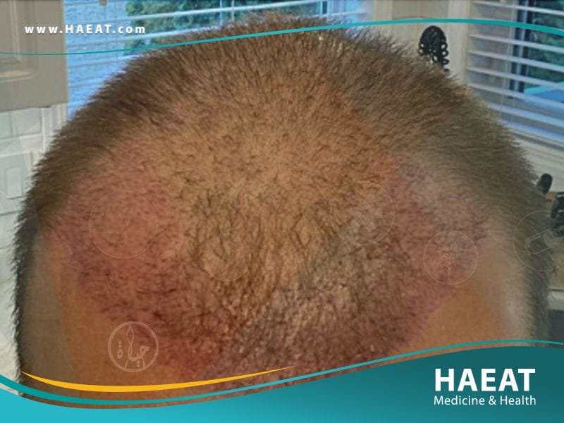 الفرق بين زراعة الشعر بتقنية FUE وتقنية البيركوتان