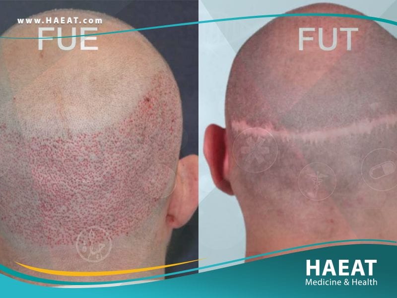 الفرق بين زراعة الشعر بتقنية FUE وتقنية البيركوتان