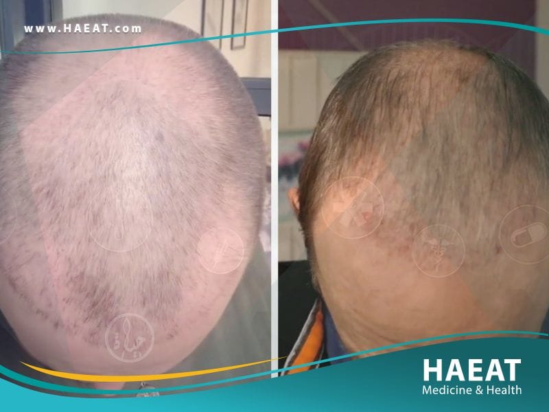 الفرق بين زراعة الشعر بتقنية FUE وتقنية البيركوتان