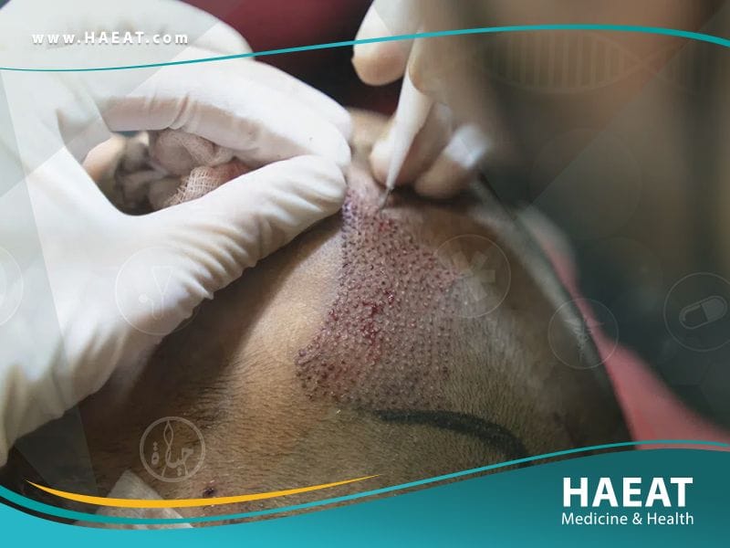 الفرق بين زراعة الشعر بتقنية FUE وتقنية الخلايا الجذعية