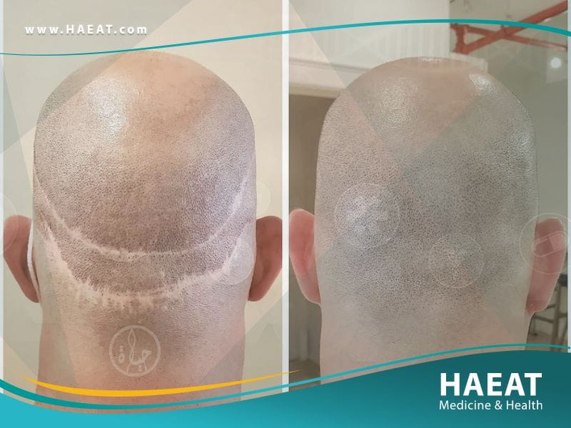 الفرق بين زراعة الشعر بتقنية FUE وتقنية الخلايا الجذعية