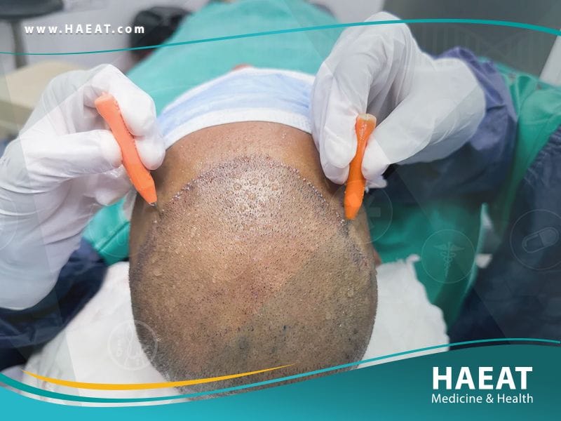 الفرق بين زراعة الشعر بتقنية FUE وتقنية الخلايا الجذعية