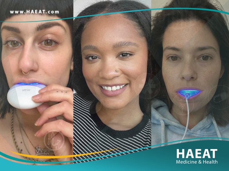 تبييض الاسنان بالمنزل