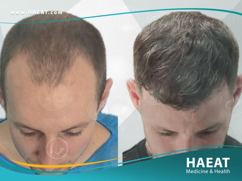 تجارب زراعة الشعر بالصور