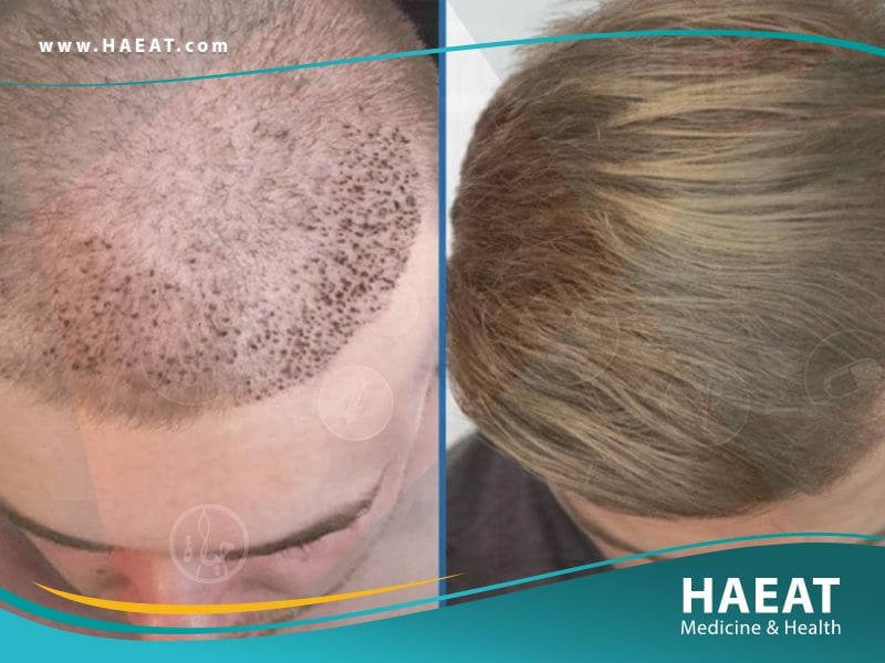 تجارب زراعة الشعر بالصور