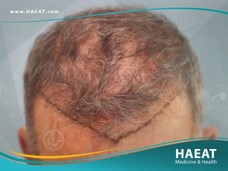 تجارب زراعة الشعر بالصور