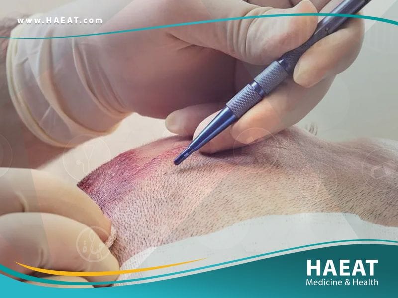 تجارب زراعة الشعر بالصور