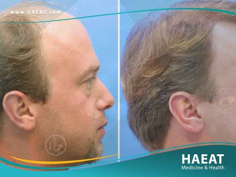 تجارب زراعة الشعر بالصور