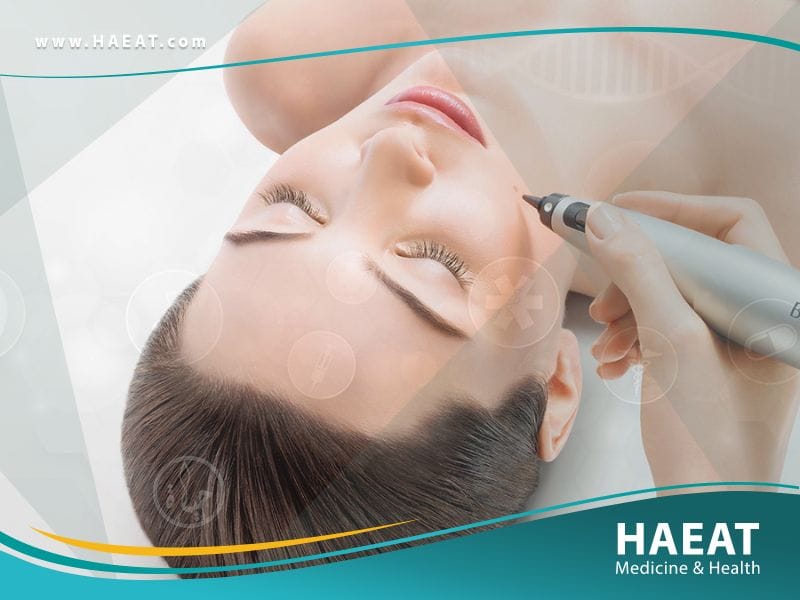 تسحيج الجلد Dermabrasion