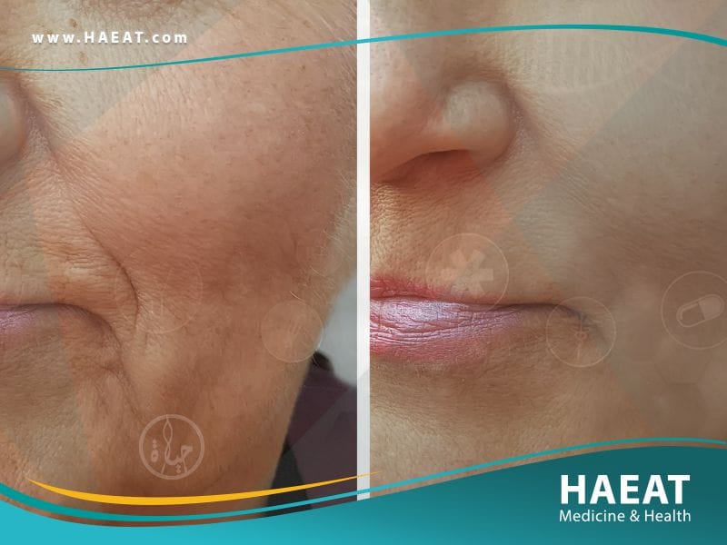 تسحيج الجلد Dermabrasion