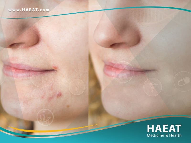 تسحيج الجلد Dermabrasion