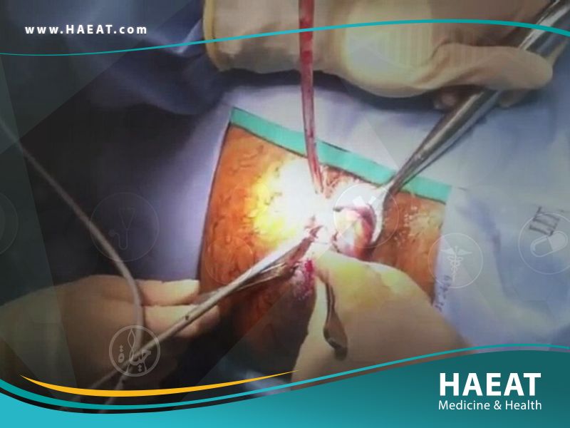 جراحة البواسير 27 جراحة البواسير