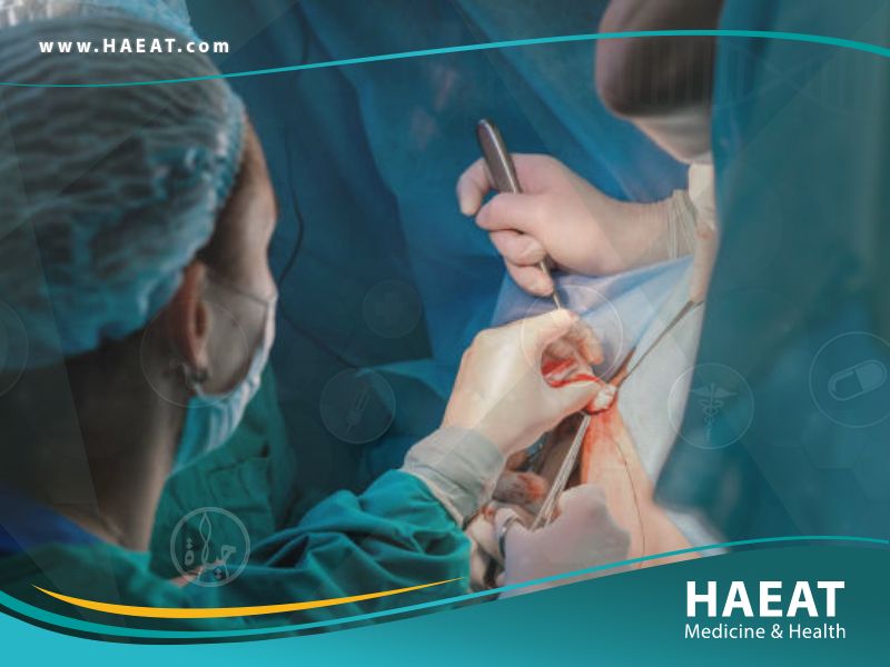جراحة البواسير 28 جراحة البواسير