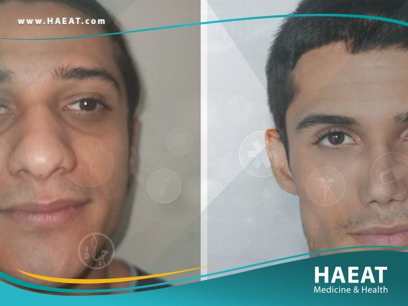 جراحة التجميل في تركيا