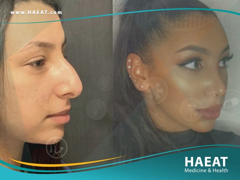 جراحة التجميل في تركيا