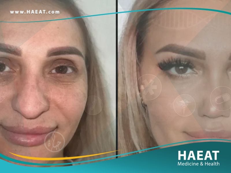 جراحة التجميل في تركيا