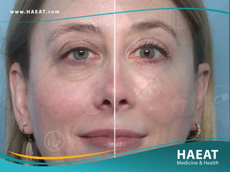 جراحة الجفون