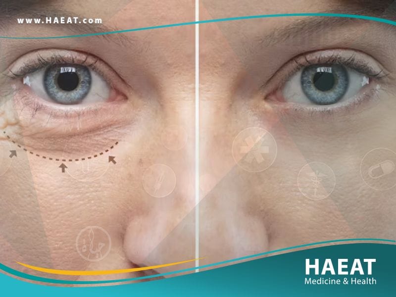 جراحة الجفون