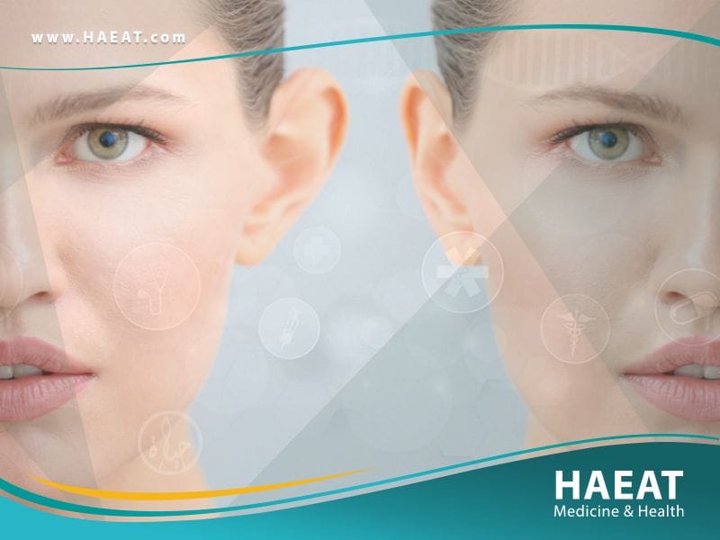 جراحة الجفون