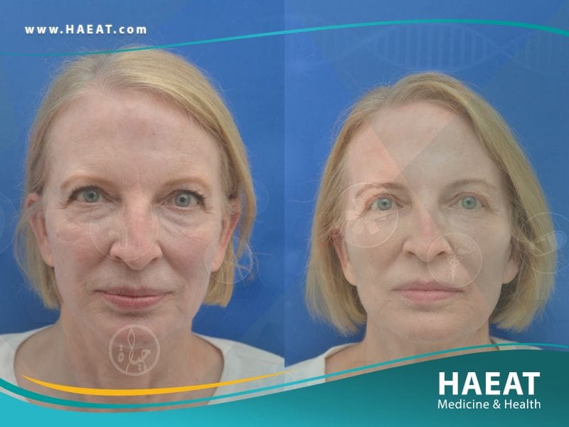 جراحة الجفون