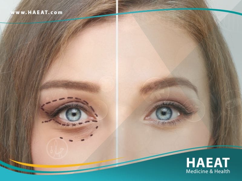 جراحة الجفون