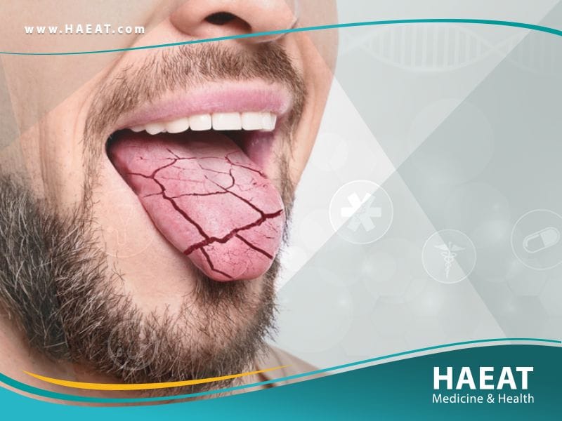 جفاف الفم وصحة الفم