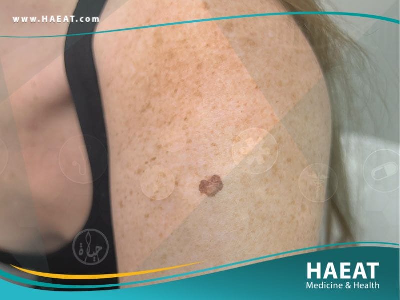 سرطان الجلد