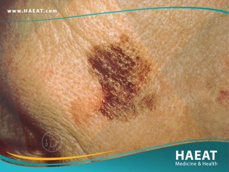 سرطان الجلد