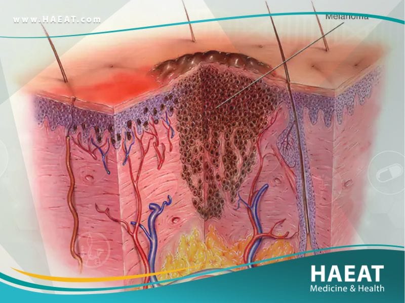 سرطان الجلد