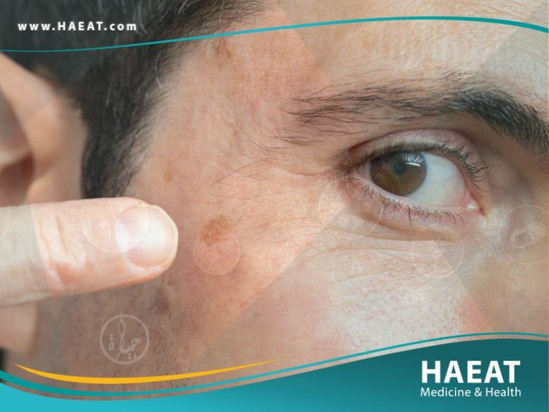 سرطان الجلد