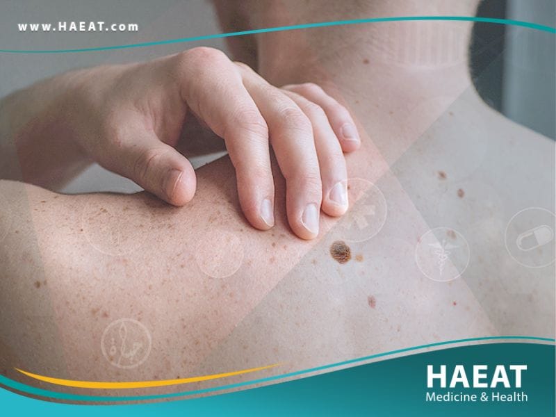 سرطان الجلد