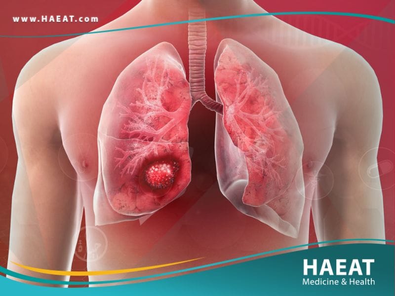 سرطان الرئه